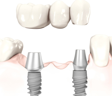 Dental Implants